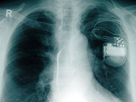 [Image: 812664539-herzschrittmacher-gesundheit-3K09.jpg]