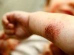 Neurodermitis individuell behandeln- Therapie auf das Krankheitsbild abstimmen