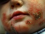 Neurodermitiker muss rezeptfreie Medikamente selbst zahlen