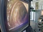 Darmkrebs: Männer sollten früher zur Vorsorge