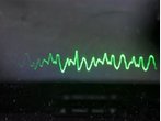 Implantierter Defibrillator rettet Mann bei Messerstecherei in San Diego