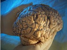 Parkinson: Immer mehr Deutschen droht die unheilbaren Krankheit