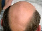 Schönheits-OPs bei Männern: Wie eine Haartransplantation funktioniert